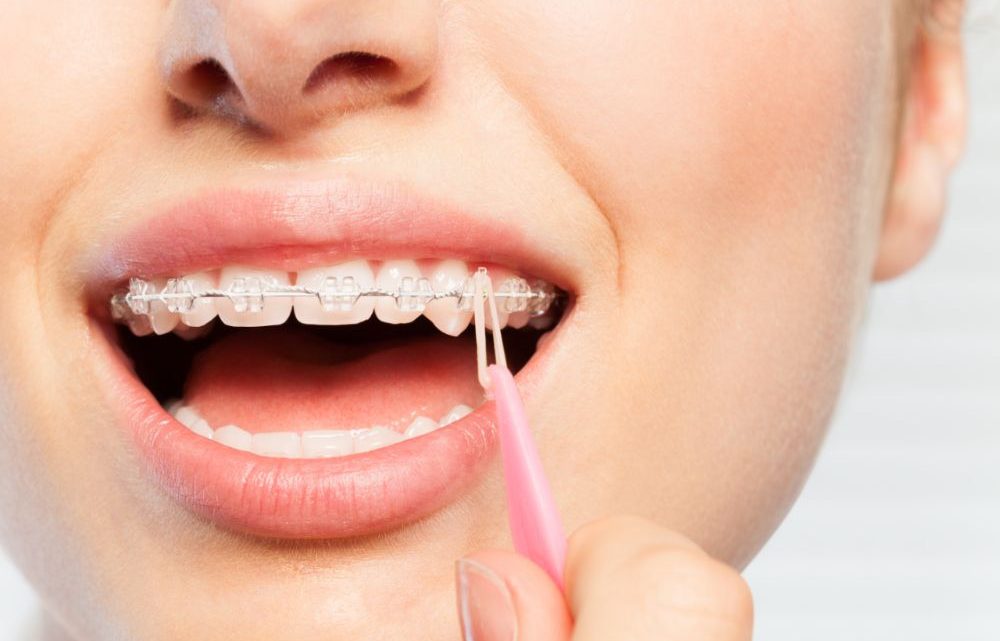 The different kinds of braces